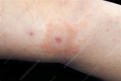 Viral urticaria - Stock Image - C021/3310 - Science Photo Library