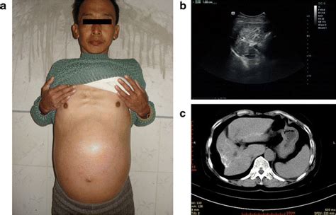 Clinical features of advanced schistosomiasis. a Abdominal sign:... | Download Scientific Diagram