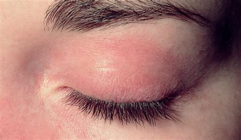 Lash Lice Are Becoming More Common in Eyelash Extensions, Doctors Warn | 22 Words