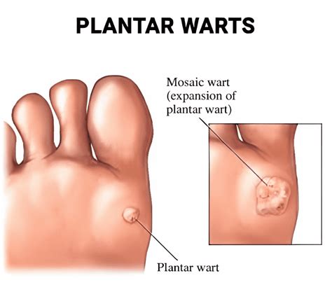 Plantar Warts : Precision Footcare: Podiatrists