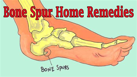 Effective Home Remedies To Get Rid Of Bone Spur | Bone Spur Treatment - YouTube