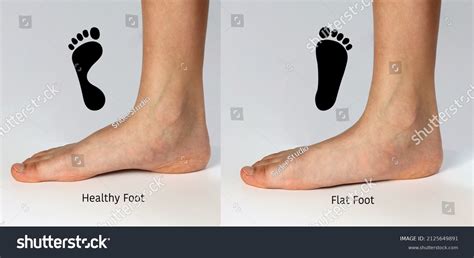 Premium Vector Foot Deformity Types Medical Disease Infographics Hollow Flat And Normal Foot ...