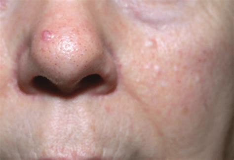 Characteristic multiple dome-shaped papules on the nose and cheek of a... | Download Scientific ...