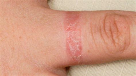 Can Dogs Cause Contact Dermatitis