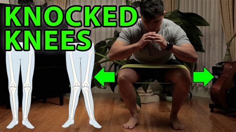 3 Power Exercises For Knocked Knees | Genu Valgus, Flat Feet - YouTube