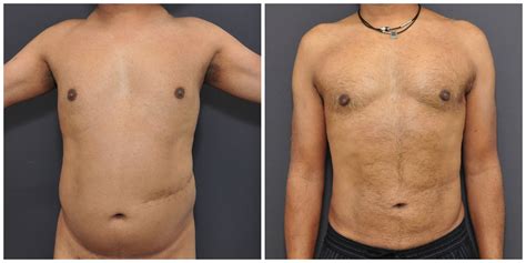 Liposuction for Men San Francisco | David Sieber, M.D.