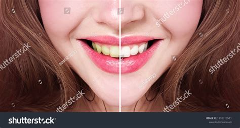 Bleaching Teeth Before After Stock Photo 1310310511 | Shutterstock