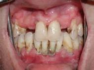 Periodontal Disease - Assignment Point