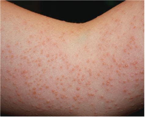 Did going on vacation cause this intensely pruritic rash? | Consultant360