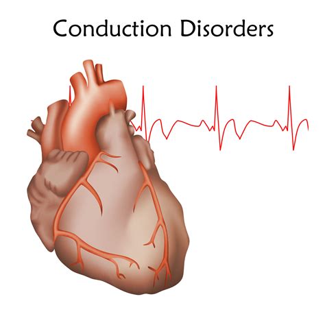 Conduction Disorders | Virginia Arrhythmia Consultants