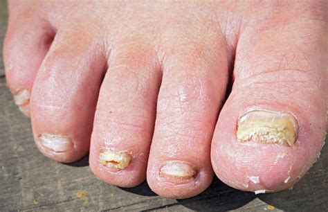 can toenail fungus cause foot pain - Toenail Fungus Treatment | Toenail Fungus Treatment
