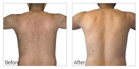 Laser Hair Removal | Effectively Eliminate Unwanted Hair | Affordable