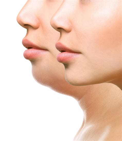 What Causes a Double Chin?: Skinworks Dermatology: Dermatology