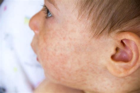 Food Allergy Skin Rash Baby