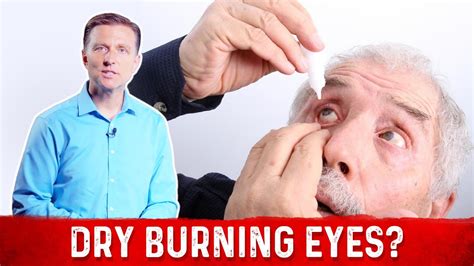 What Is Dry Burning Eyes & How To Get Rid Of Dry Eyes? – Dr.Berg - YouTube