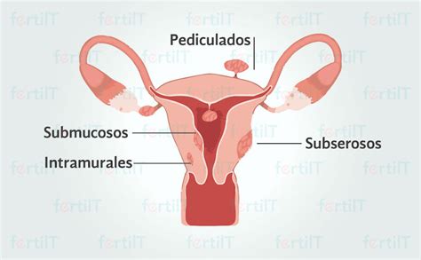 TRATAMIENTO DE MIOMATOSIS UTERINA PDF