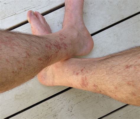 Hiker's rash: red rash between knee and ankle after hiking for several hours