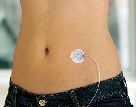 Medtronic Insulin Pump Infusion Sets