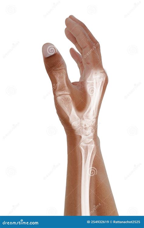 Hand ,wrist X-ray Oblique View,Medical Image Concept Stock Image ...