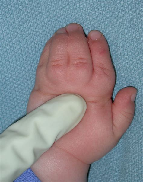 Photo of Syndactyly Involving Four Fingers | Congenital Hand and Arm ...