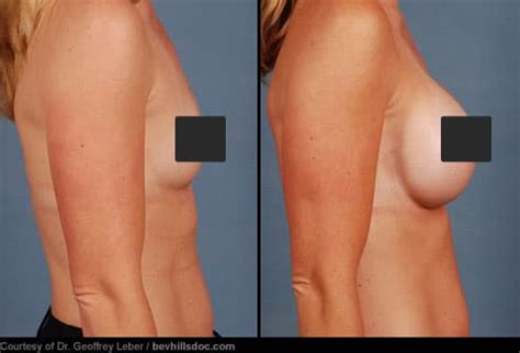 Cosmetic Surgery Before-and-After Pictures: Liposuction, Tummy Tuck ...