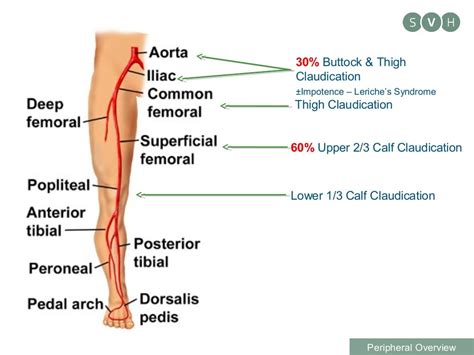 Determining a vascular cause for leg pain and referrals