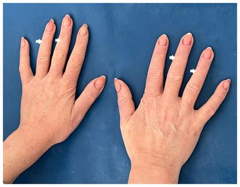 Slight skin induration of the hands (white arrows). | Download Scientific Diagram