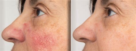 Dermatology Associates | Rosacea