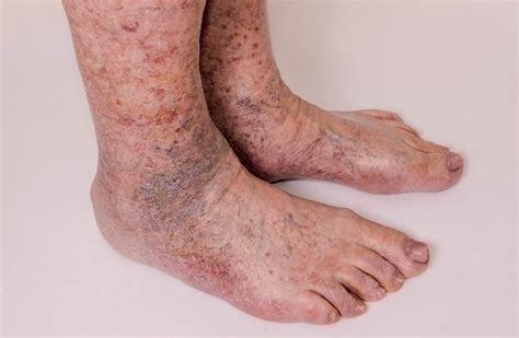 The Possible Causes Of Feet Discoloration | lupon.gov.ph