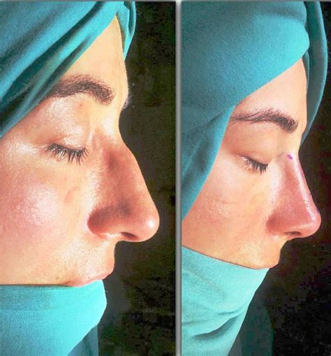 Nose-Job-In-Izmir-Turkey-To-Remove-A-Bump-Before-And-After-Pics.jpg 974 ...