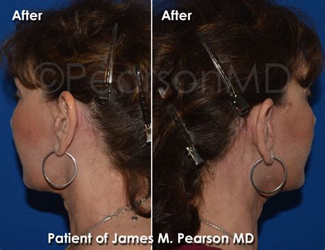 Neck Lift - Dr. James Pearson Facial Plastic Surgery