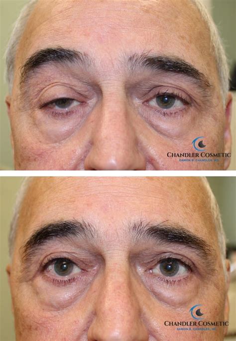 Ocular Myasthenia Gravis Eyelid Surgery