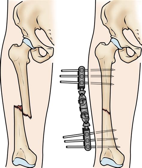 Fracturas de la diáfisis femoral (ruptura del hueso del muslo) (Femur Shaft Fractures (Broken ...