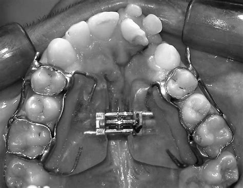 Intraoral view of the Haas palatal expander with hooks for elastics. | Download Scientific Diagram