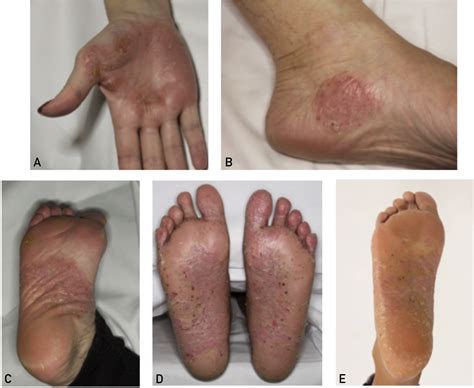 Clinical Features, Etiologic Factors, Associated Disorders, and Treatment of Palmoplantar ...