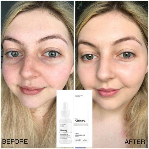 The Ordinary Alpha Arbutin Before And After - How To Use The Ordinary Niacinamide Alpha Arbutin ...