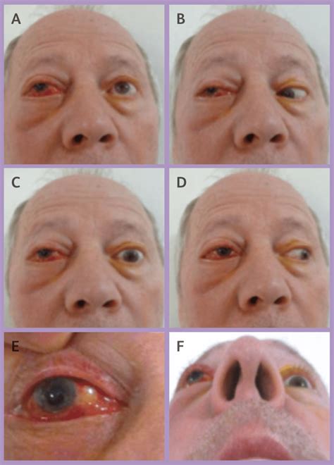 Retrobulbar haemorrhage – EMbeds.co.uk