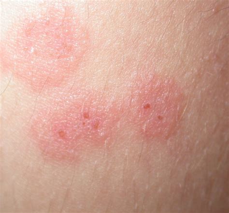 Pityriasis, Pityriasis Lichenoides - Pictures, Causes, Symptoms, Treatment, This is then ...