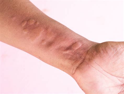 What is urticaria? - RefLab ApS