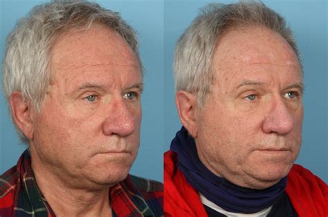 Before and After - Rhinophyma |Dr. Sidle