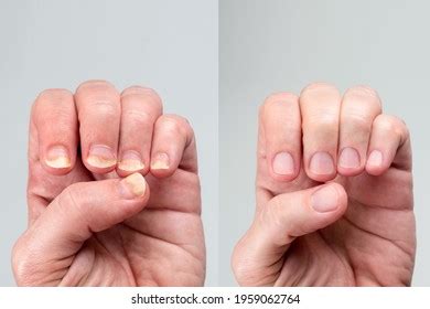 401 Nails Before After Images, Stock Photos, 3D objects, & Vectors | Shutterstock