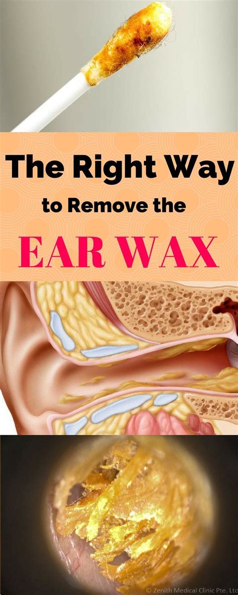 Pin by Hearing Loss Health on Hearing Loss | Ear wax, Healthy tips, Ear cleaning wax