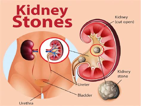 Ayurvedic remedies for kidney stones | TheHealthSite.com
