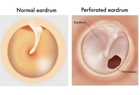 Let’s talk about ruptured eardrum – what is it and how to treat it ...