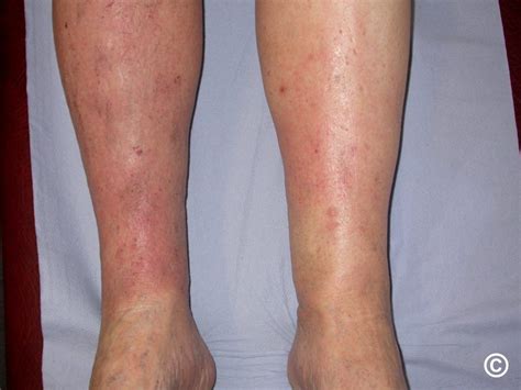 Gravitational eczema, varicose eczema