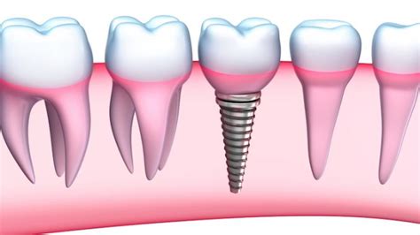 Implant Dental Surgery Recovery