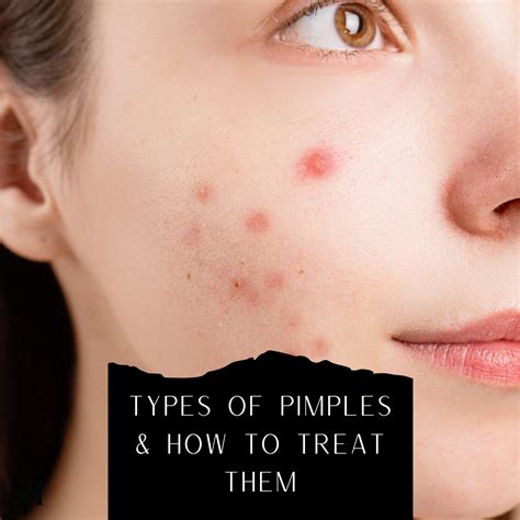 Types Of Pimples & How To Treat Them - Skin Harmonics