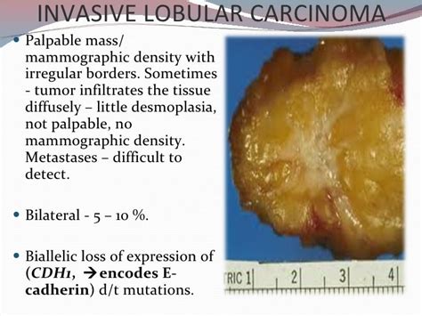 Pin op "Lobular carcinoma"