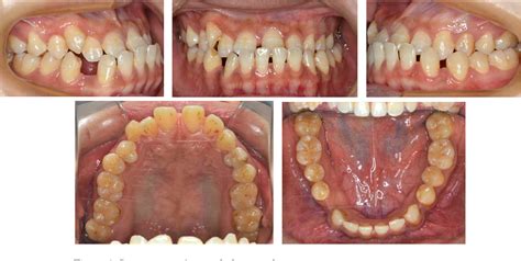 Figure 2 from A Modified Surgery-First Approach for Mandibular Prognathism with Proclined ...