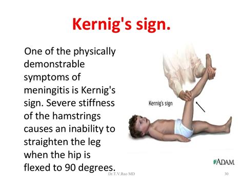 Bacterial meningitis